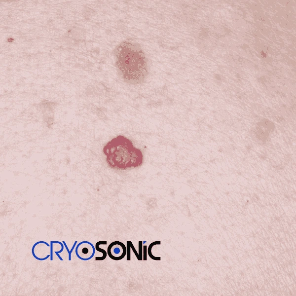 Looking for pain free cherry angioma removal treatment Bicester? Call our team today! Bicester