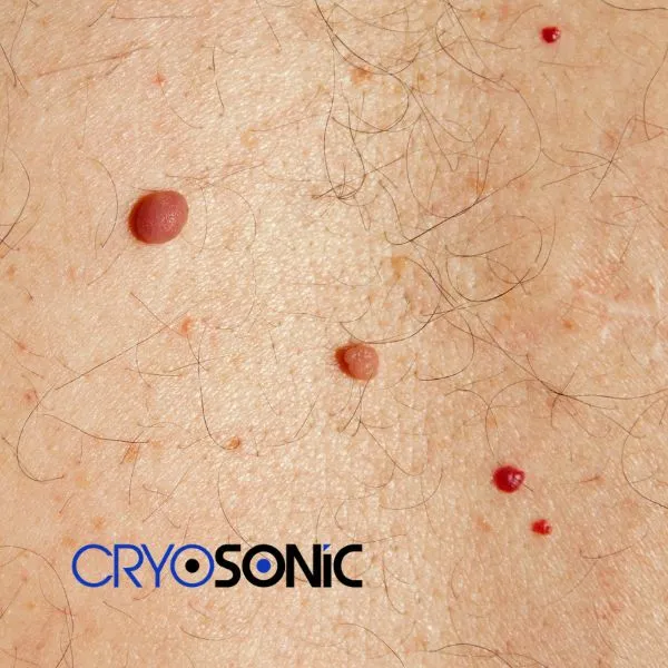 get cherry angioma removal treatment today! Bicester