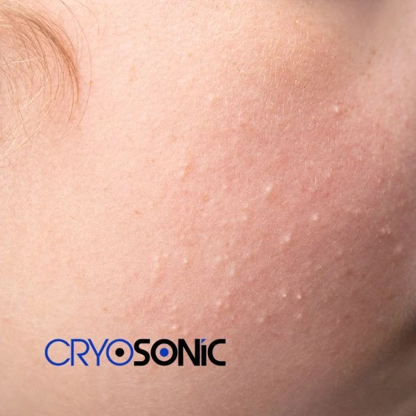 Are you looking for milia removal treatment? Contact our team today Bicester