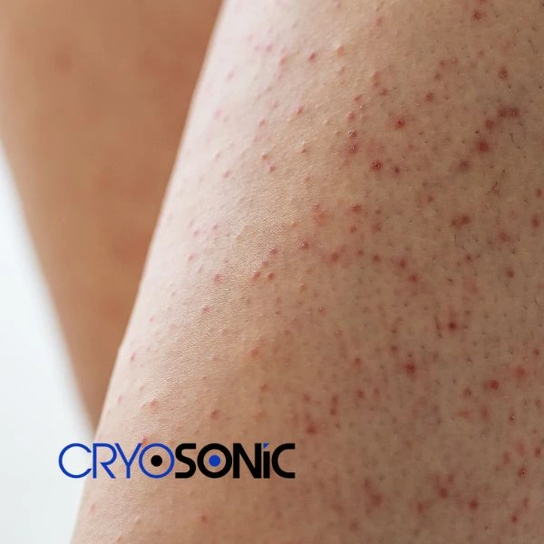 Looking for Seborrhoeic Keratosis removal Bicester treatment? Call our consultants today in Bicester