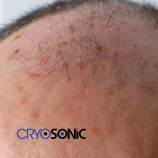 Access Seborrhoeic Keratosis removal from the comfort of your own home! Call us today in Bicester