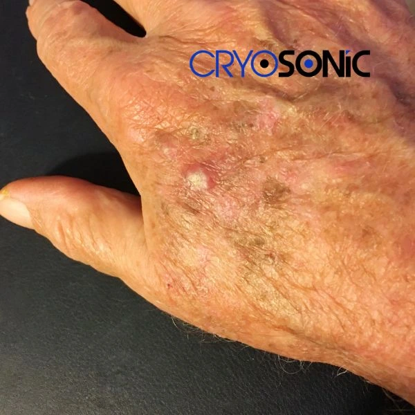 Understand more about actinic keratosis treatment today Bicester