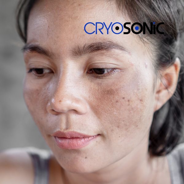 Ready to start age spots removal? Contact our team today in Bicester