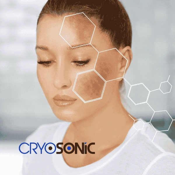 Are you looking for age spot removal treatment? Contact Cryosonic today in Bicester