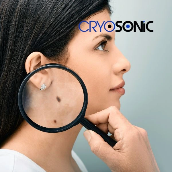 Do you want to learn more about benign moles removal treatment? Call our team today Bicester