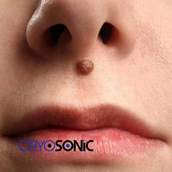 Start your benign moles removal treatment today Bicester