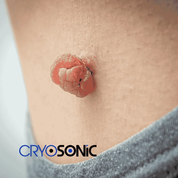 Book your skin tags removal Bicester from comfort of your own home! Bicester