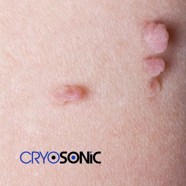 Are you looking for fast effect skin tag removal Bicester? Book in NOW! Bicester