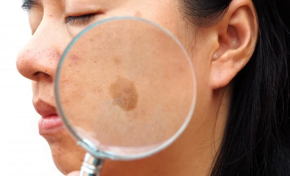 How Seborrheic Keratosis Bicester appears on the skin Bicester