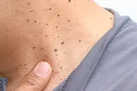 Seborrheic Keratosis: Understanding Skin Changes and CryoPen Treatment Options Bicester