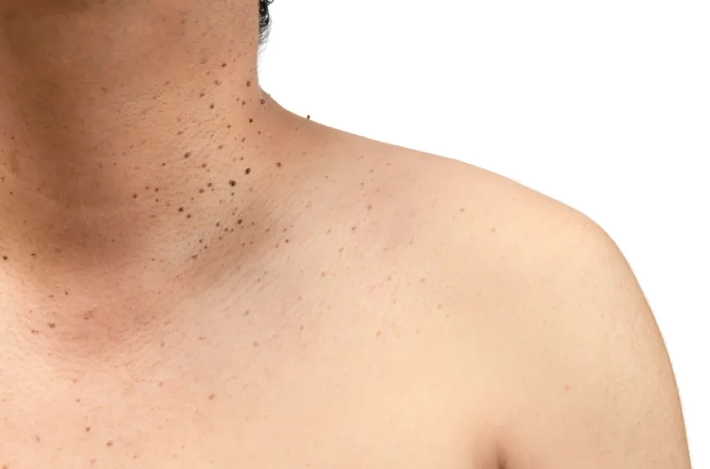 How to Maintain Healthy Skin After Treatment Bicester? Bicester