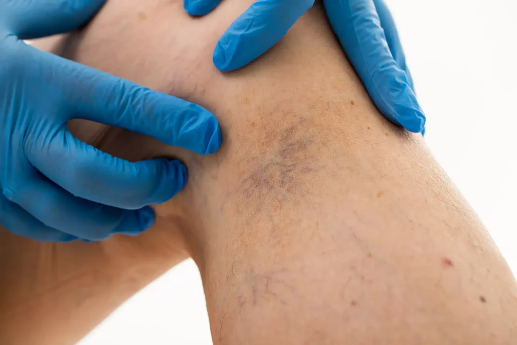 Spider Veins vs. Spider Angiomas: Understanding the Differences in CryoPen Bicester