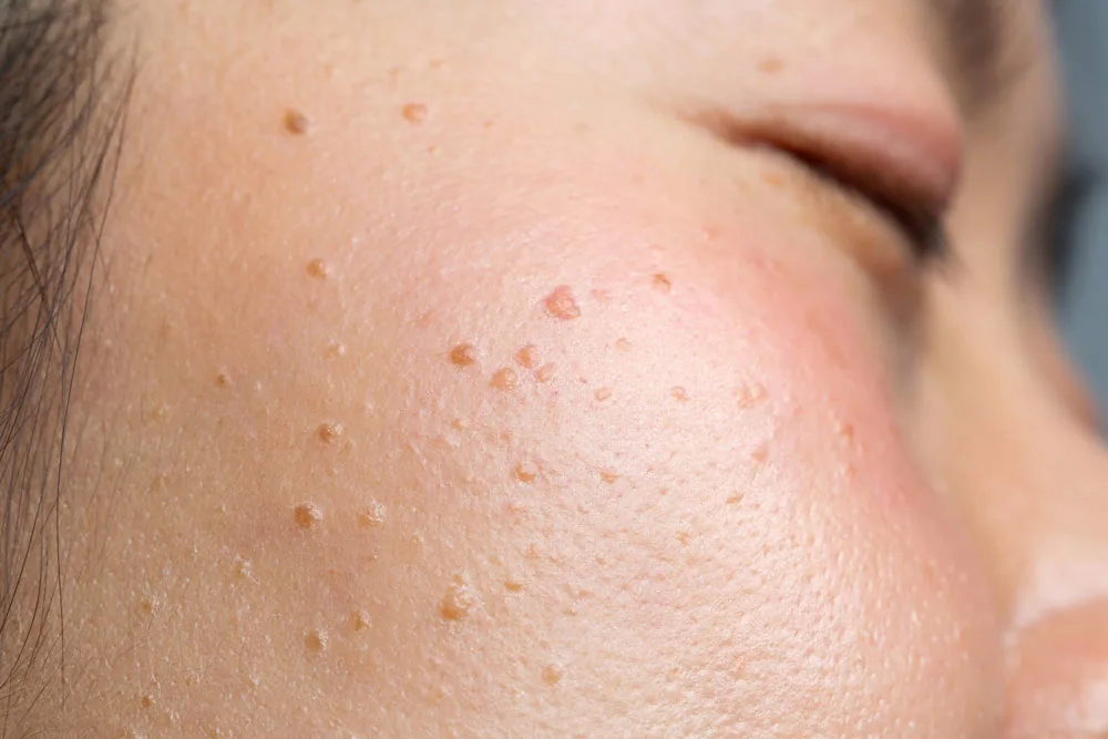 Why Choose CryoPen for Seborrheic Keratosis Bicester Bicester