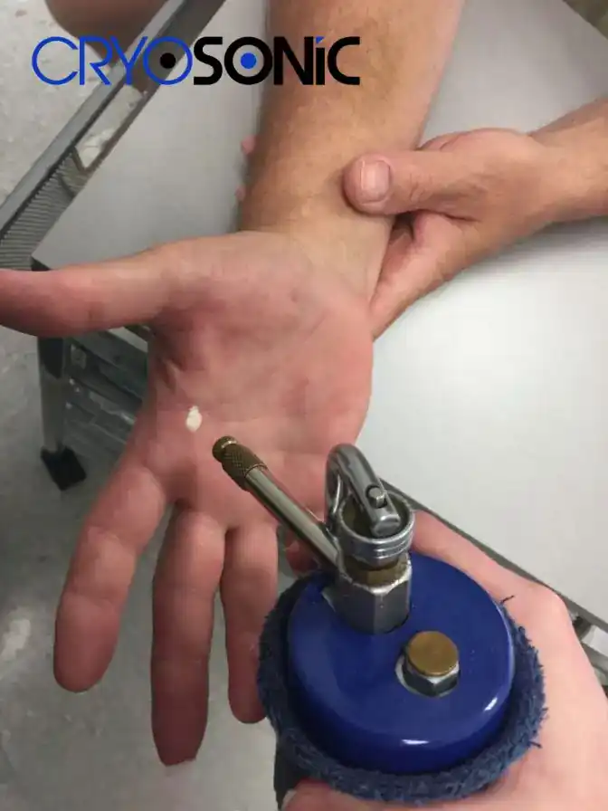 Temperature Differences: OTC vs Medical-Grade Cryotherapy Bicester